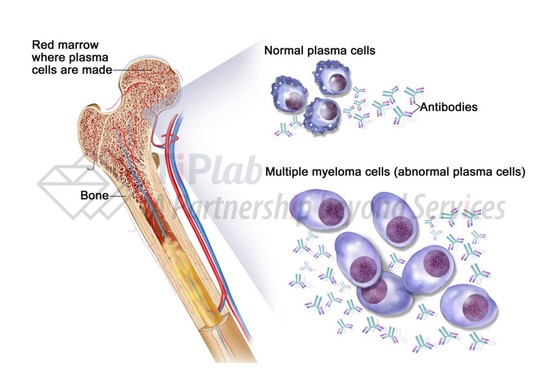 参见：Multiple myeloma: Cancer in plasma cells